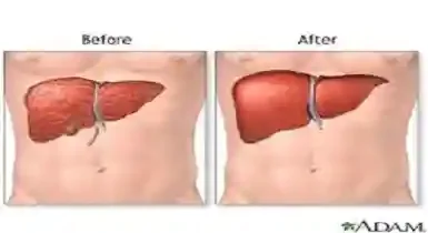 What is Liver Transplant? Understand Facts and Benefits