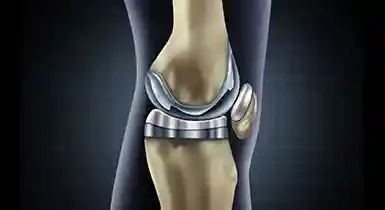Knee Replacement: Golden Solution for Metal Implant Allergies