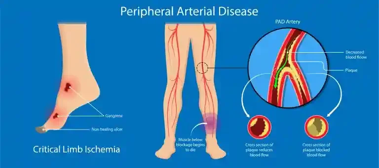 Quick intervention of Peripheral Artery Disease – saved 65yr old patient