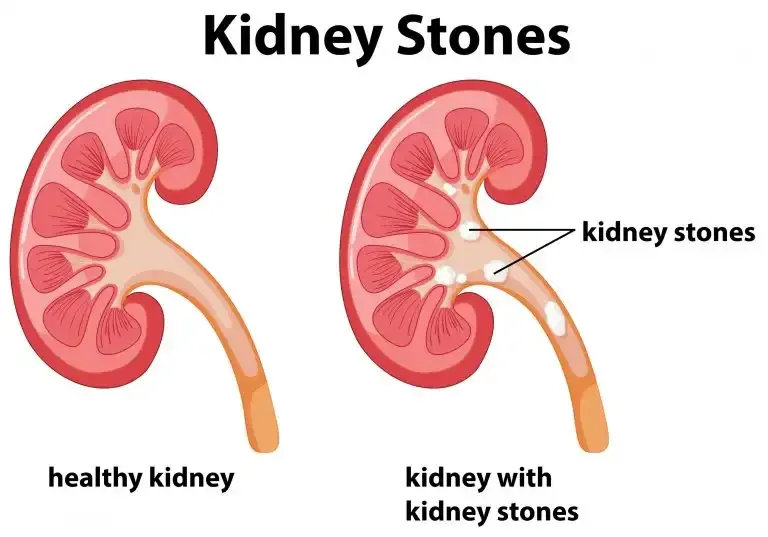 Kidney Stones: Symptoms, Causes, Types & Treatment