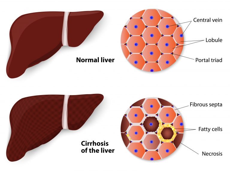 Chronic Liver disease