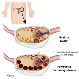 Polycystic Ovarian Syndrome