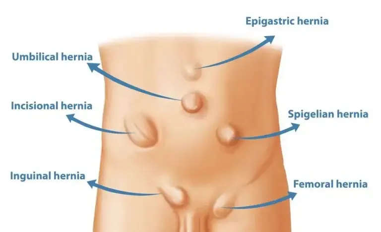 What Causes Hernia? its Types, Diagnosis & Advanced Treatment