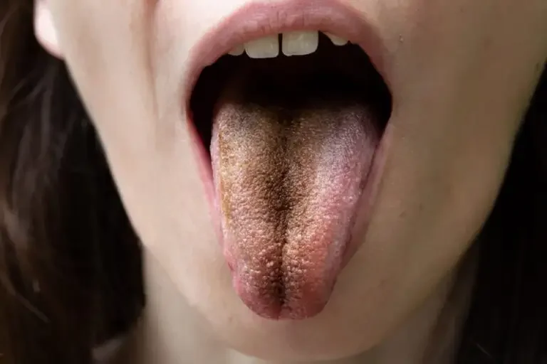 Stroke survivor develops ‘black hairy tongue’; know all about this condition from experts