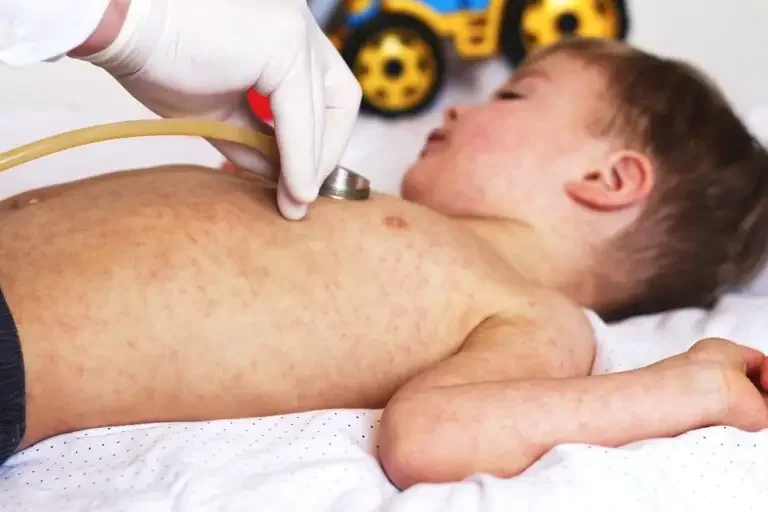 Why You Should Worry About Measles