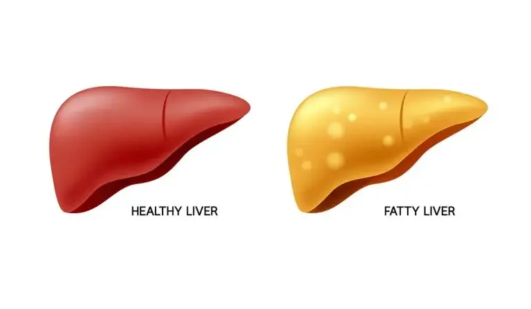 The Four Stages Of Fatty Liver Disease- Explained