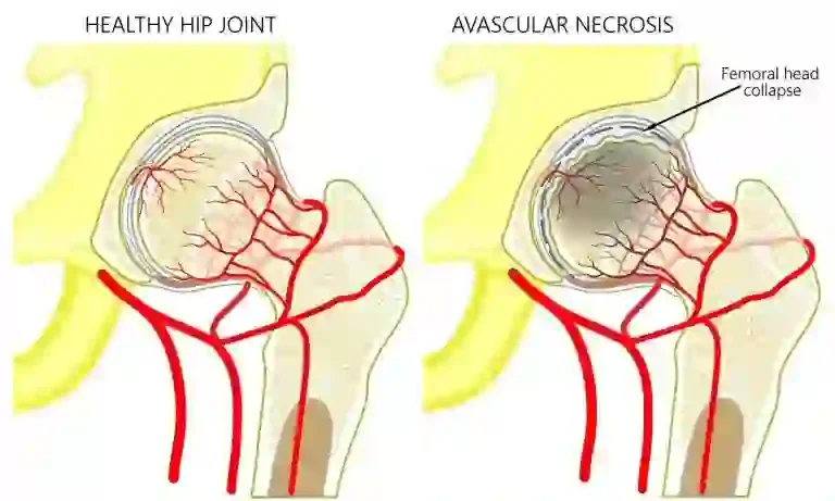 Avascular Necrosis Femoral Head (AVN) : Symptoms, Causes & Treatment