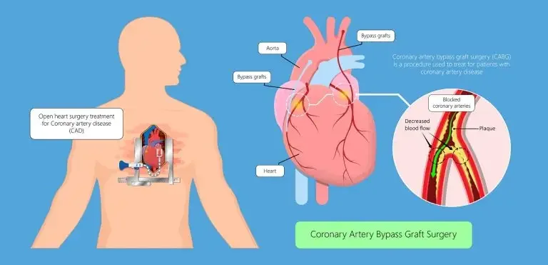 What is a Coronary Artery Bypass Graft?