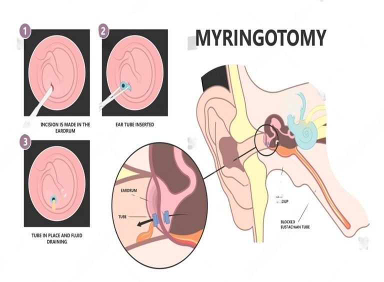 Myringotomy Surgery