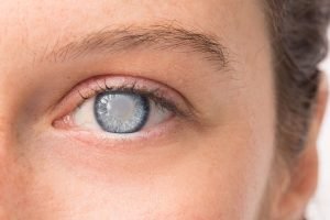 Cataracts: Symptoms, Causes & Treatment