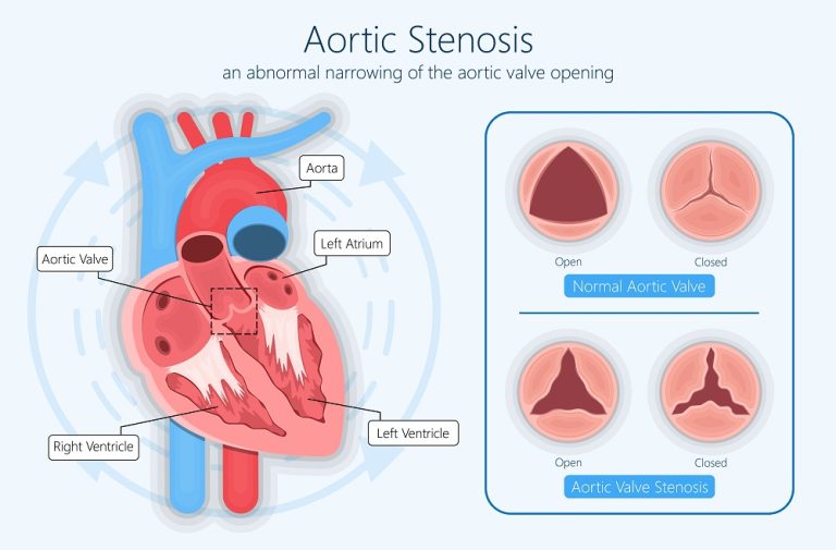 TAVI/TAVR Surgery